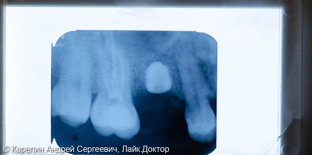 Имплантация в области зуба 2.6 - фото №4
