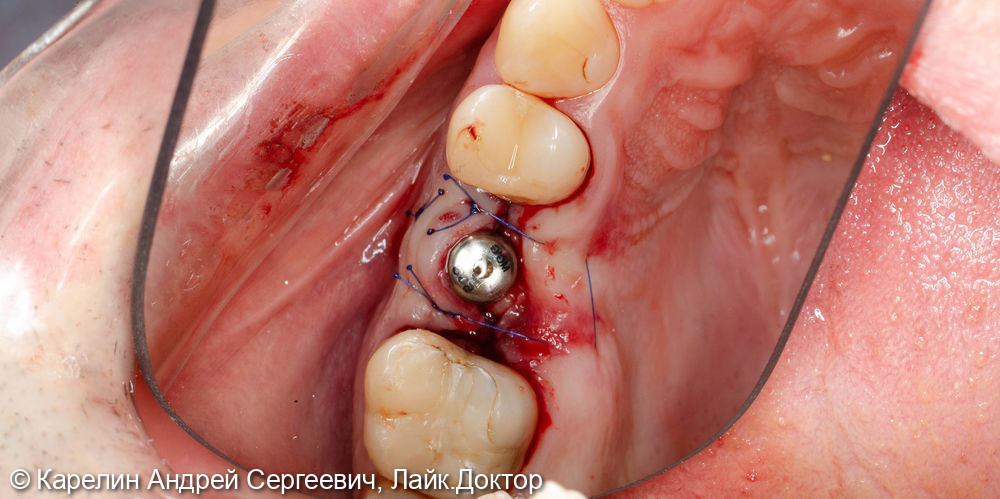 Имплантация в области зуба 2.6 - фото №5