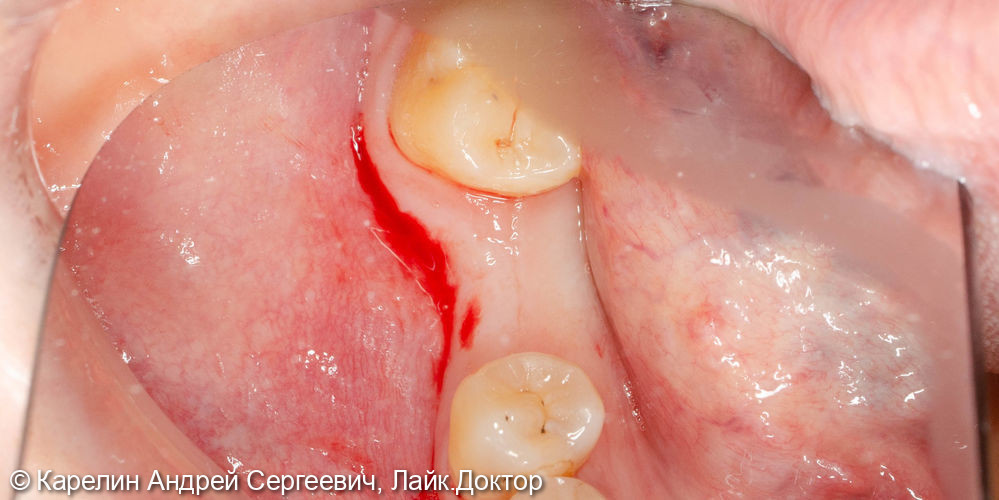 Удаление и отсроченная имплантация зуба 3.6 - фото №5