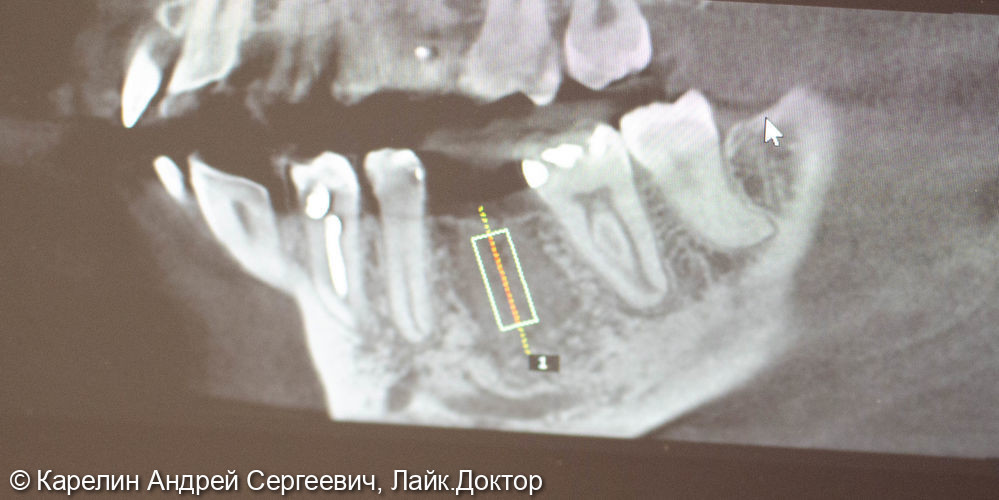 Удаление и отсроченная имплантация зуба 3.6 - фото №6