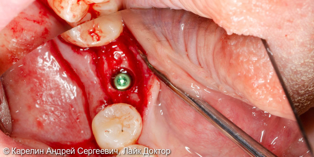 Удаление и отсроченная имплантация зуба 3.6 - фото №7