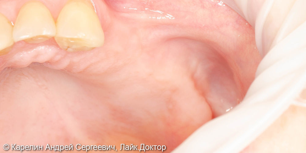 Установка имплантатов в боласти 2.4,2.5,2.6,2.7 зубов после отсроченного синус лифтинга - фото №1