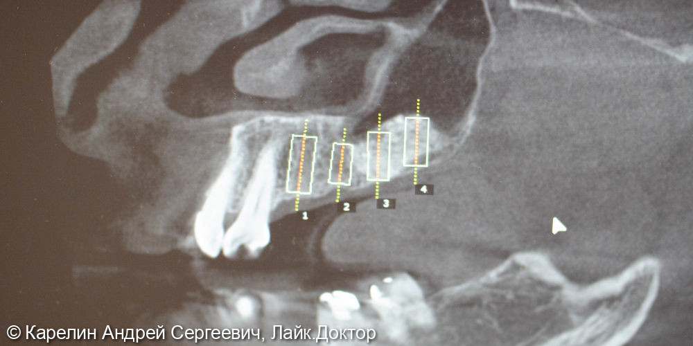 Установка имплантатов в боласти 2.4,2.5,2.6,2.7 зубов после отсроченного синус лифтинга - фото №2