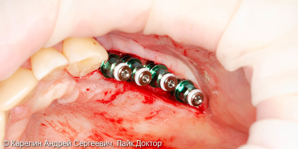 Установка имплантатов в боласти 2.4,2.5,2.6,2.7 зубов после отсроченного синус лифтинга - фото №3