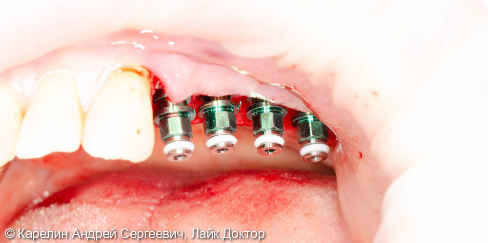 Установка имплантатов в боласти 2.4,2.5,2.6,2.7 зубов после отсроченного синус лифтинга - фото №4