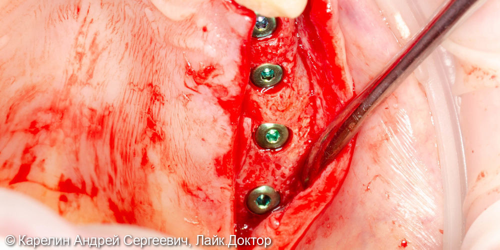 Установка имплантатов в боласти 2.4,2.5,2.6,2.7 зубов после отсроченного синус лифтинга - фото №5