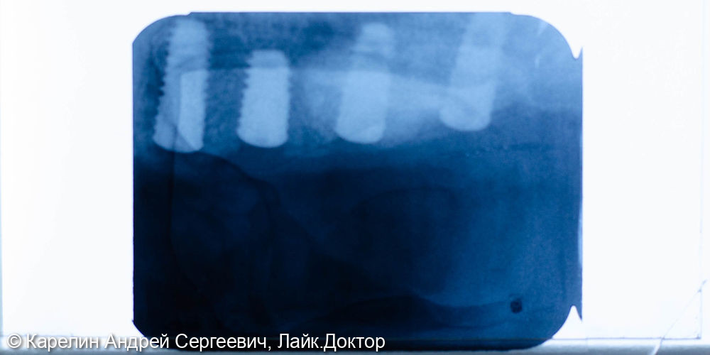 Установка имплантатов в боласти 2.4,2.5,2.6,2.7 зубов после отсроченного синус лифтинга - фото №6