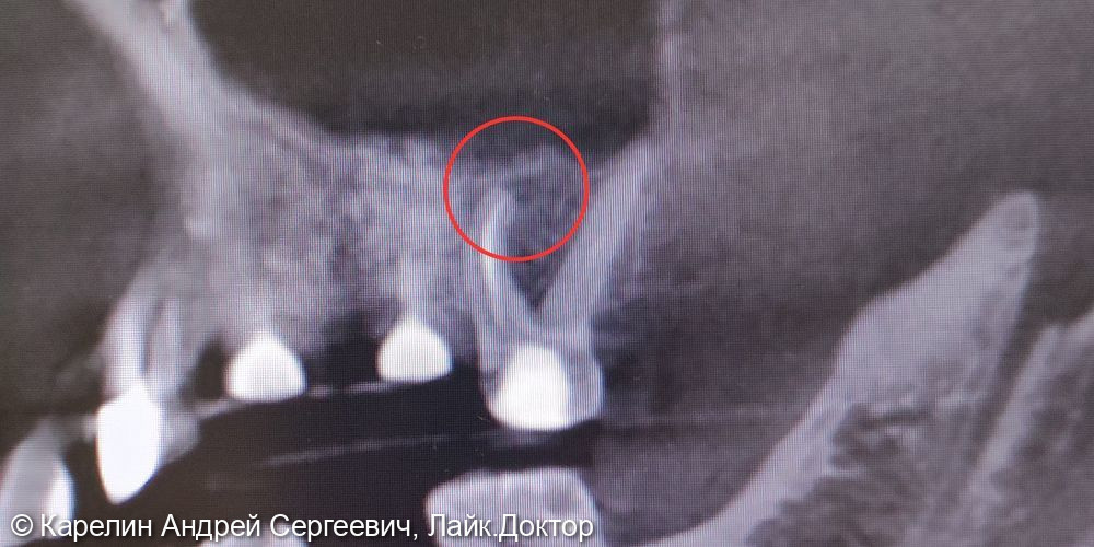 Лечение периодонтита зуба 2.6 - фото №2