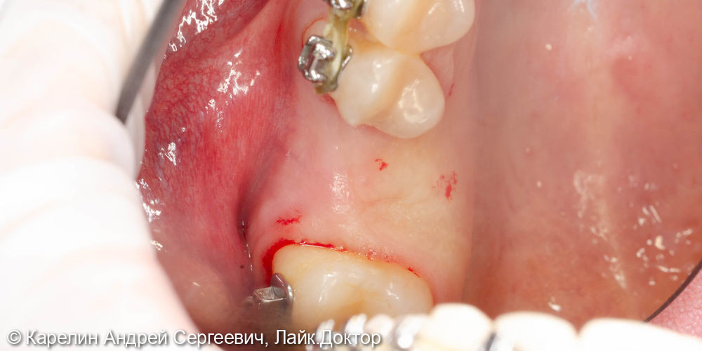 Синус-лифтинг с одномоментной имплантацией в области зуба 2.6 - фото №1