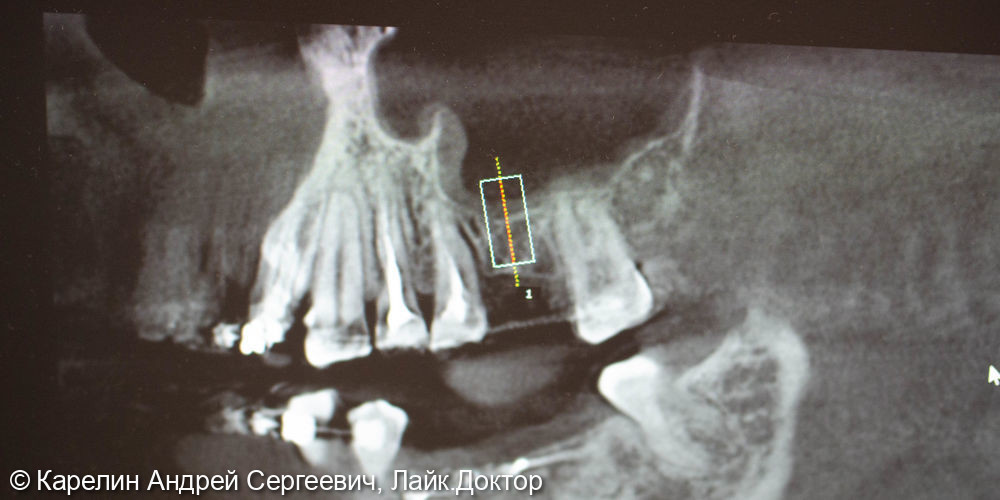 Синус-лифтинг с одномоментной имплантацией в области зуба 2.6 - фото №2