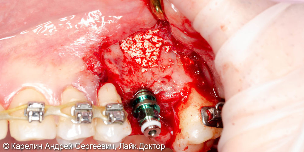Синус-лифтинг с одномоментной имплантацией в области зуба 2.6 - фото №3