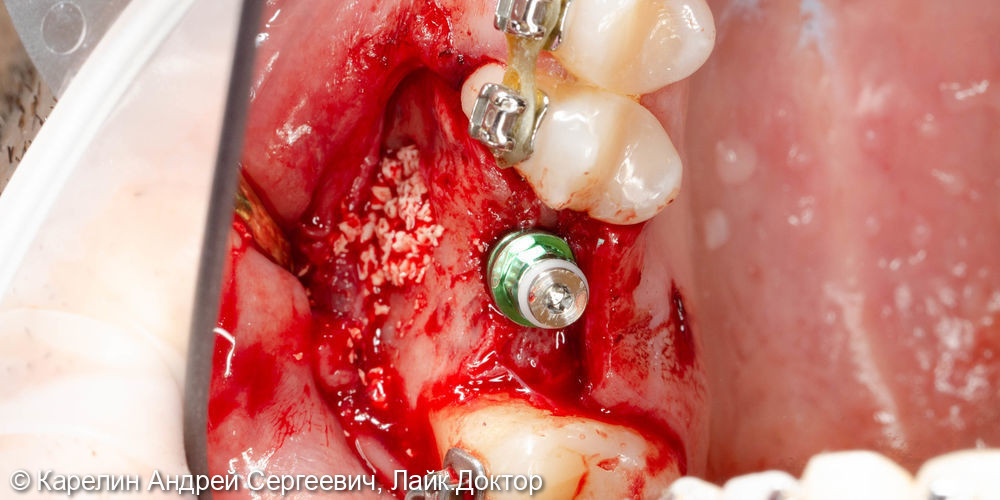 Синус-лифтинг с одномоментной имплантацией в области зуба 2.6 - фото №4