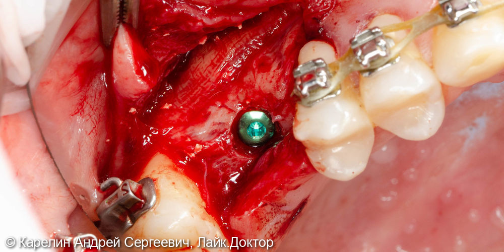 Синус-лифтинг с одномоментной имплантацией в области зуба 2.6 - фото №5