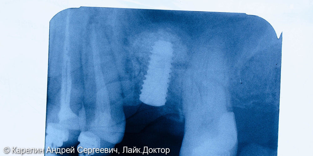 Синус-лифтинг с одномоментной имплантацией в области зуба 2.6 - фото №6