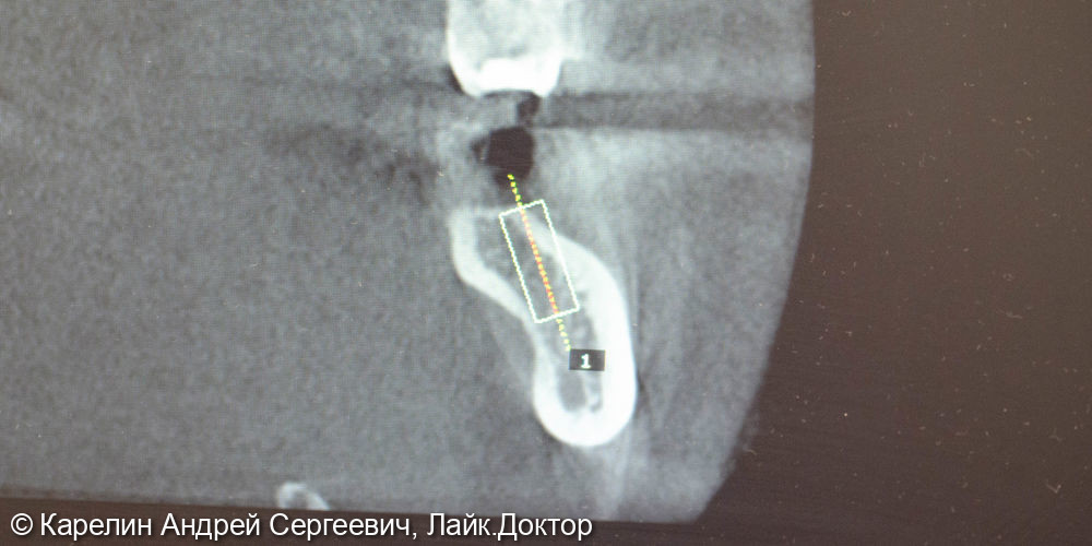Установка имплантата в область зуба 3.7 одномоментно с костной пластикой - фото №2