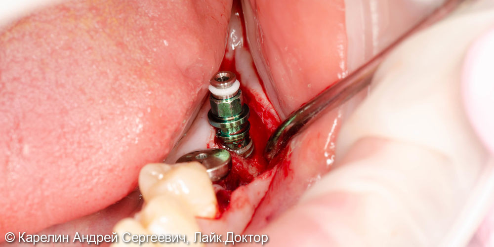 Установка имплантата в область зуба 3.7 одномоментно с костной пластикой - фото №3