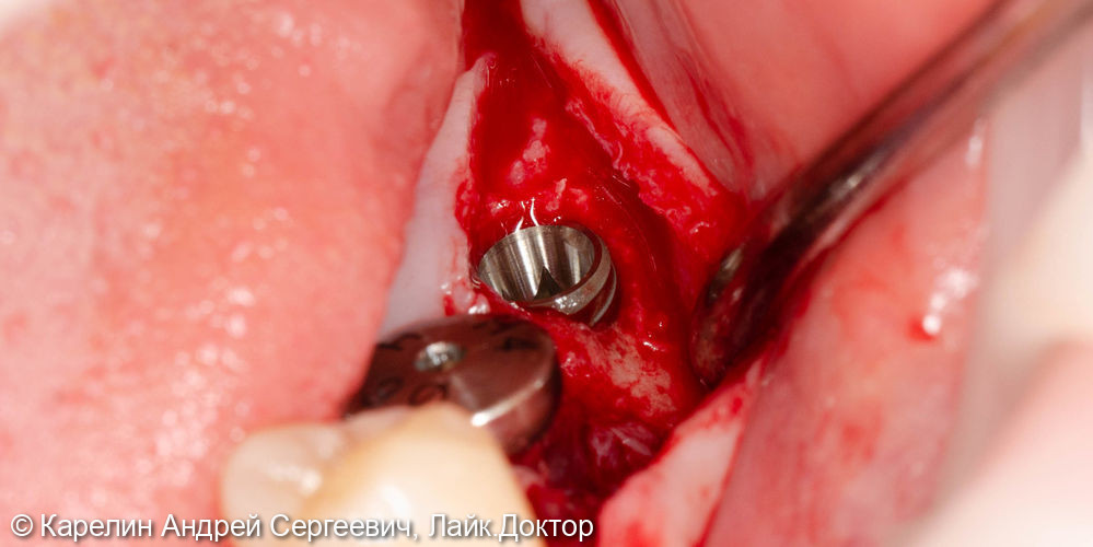 Установка имплантата в область зуба 3.7 одномоментно с костной пластикой - фото №4