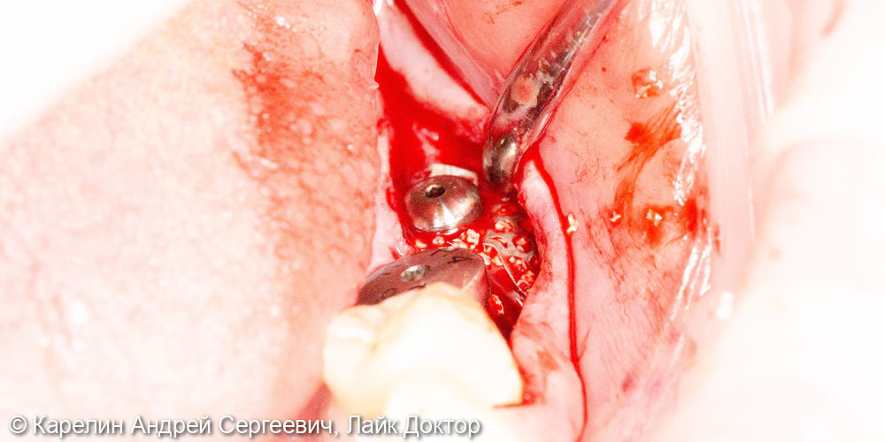 Установка имплантата в область зуба 3.7 одномоментно с костной пластикой - фото №5