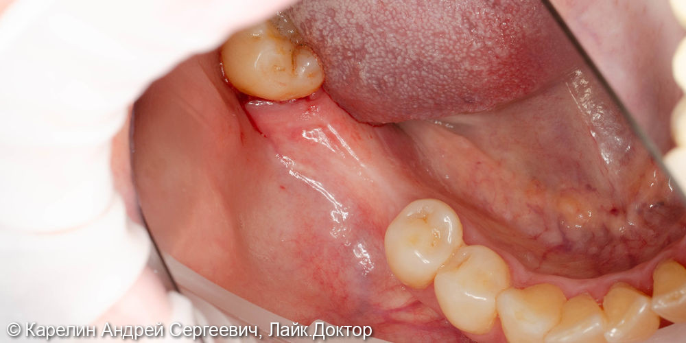 Удаление зуба 4.8, имплантация в области зубов 4.6,4.7 - фото №1