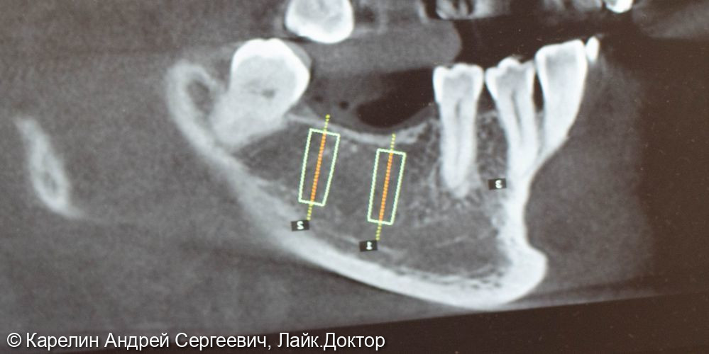 Удаление зуба 4.8, имплантация в области зубов 4.6,4.7 - фото №2