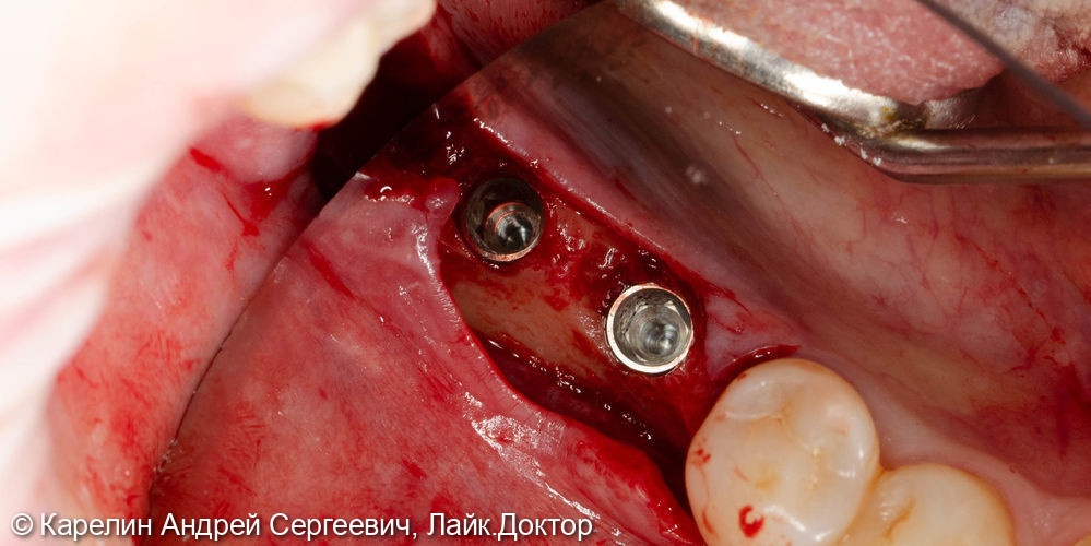 Удаление зуба 4.8, имплантация в области зубов 4.6,4.7 - фото №4