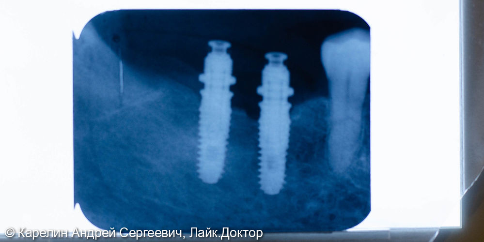 Удаление зуба 4.8, имплантация в области зубов 4.6,4.7 - фото №5
