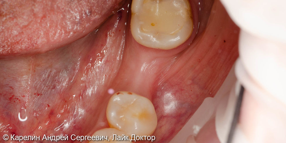 Имплантация в области зуба 3.6 - фото №1