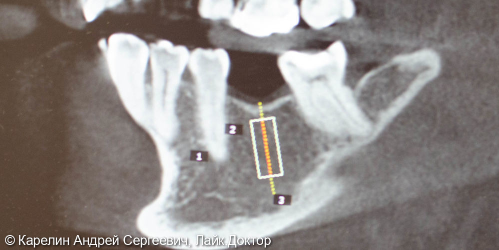 Имплантация в области зуба 3.6 - фото №2
