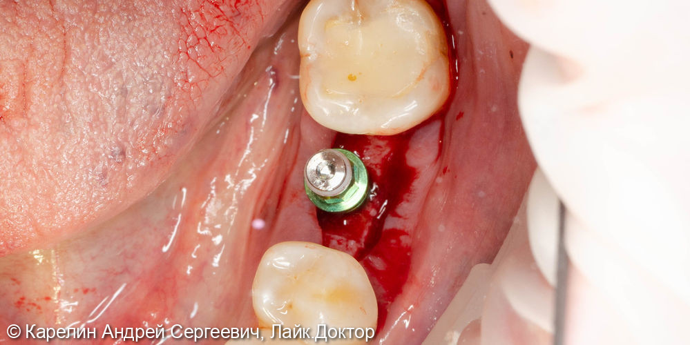 Имплантация в области зуба 3.6 - фото №3