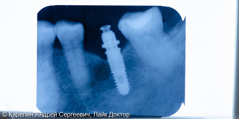 Имплантация в области зуба 3.6 - фото №4