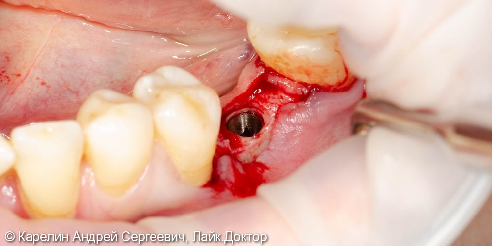 Имплантация в области зуба 3.6 - фото №5