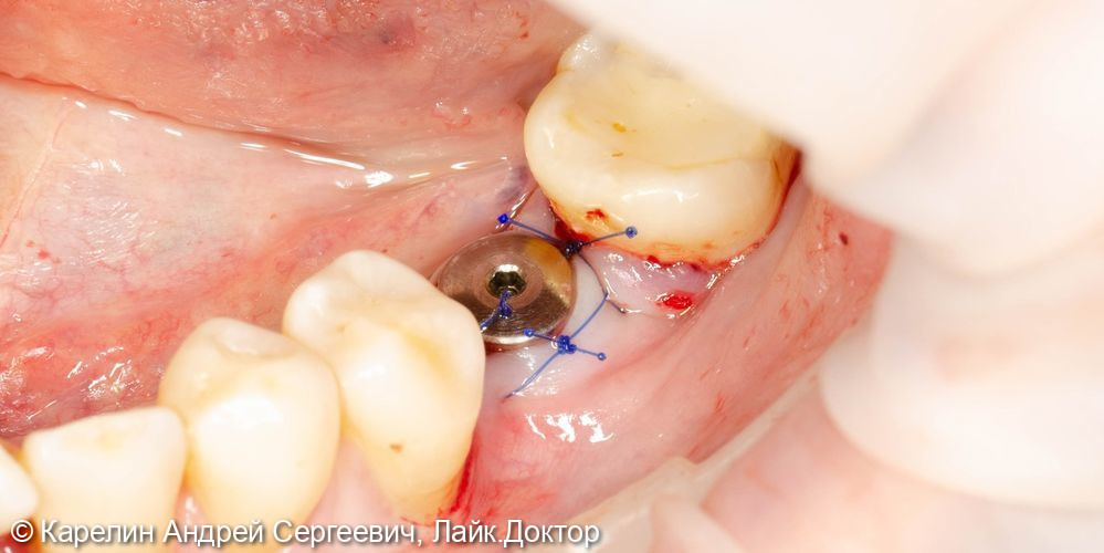 Имплантация в области зуба 3.6 - фото №6