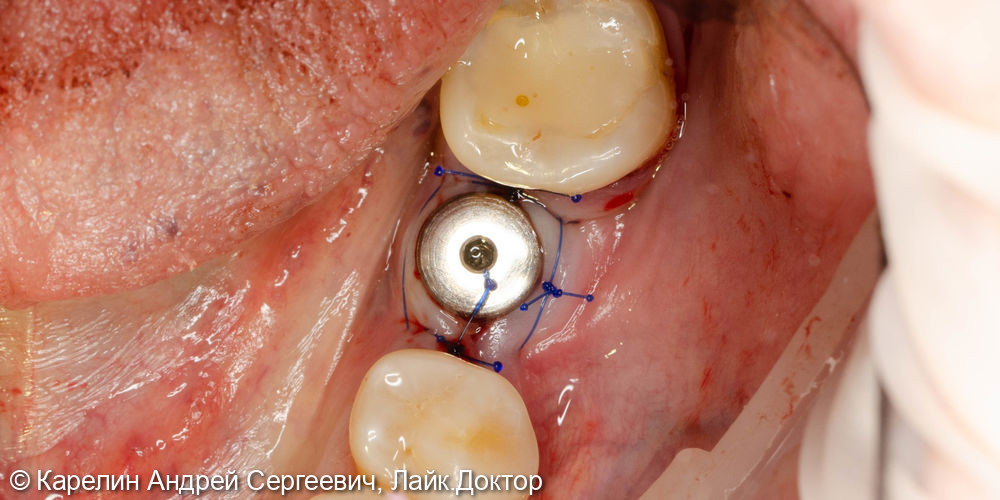 Имплантация в области зуба 3.6 - фото №7