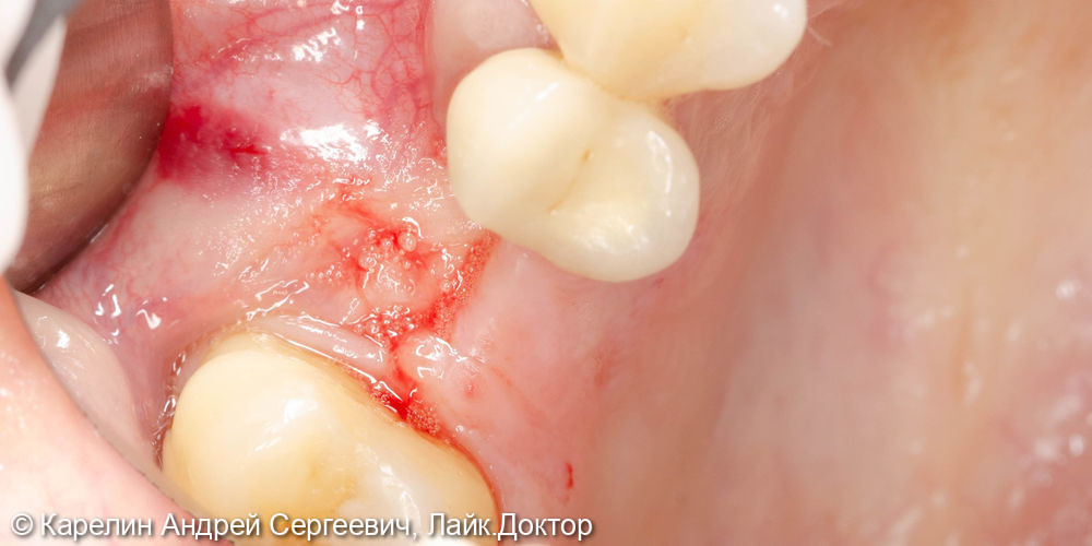 Отсроченный синус-лифтинг в области зуба 1.6 с одномоментным удалением зуба 1.5 - фото №1