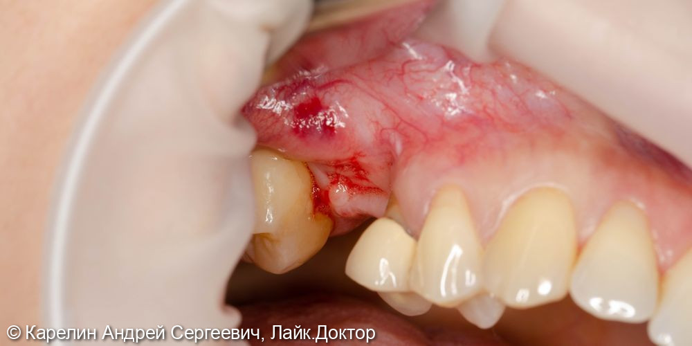 Отсроченный синус-лифтинг в области зуба 1.6 с одномоментным удалением зуба 1.5 - фото №2