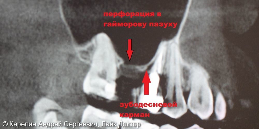 Отсроченный синус-лифтинг в области зуба 1.6 с одномоментным удалением зуба 1.5 - фото №3