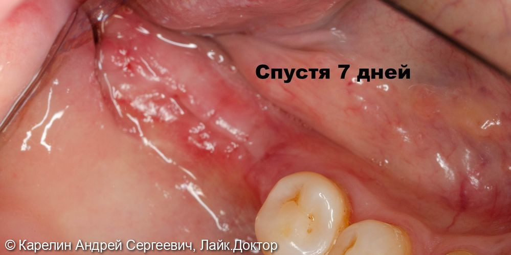 Удаление зуба 4.8, имплантация в области зубов 4.6,4.7 - фото №7