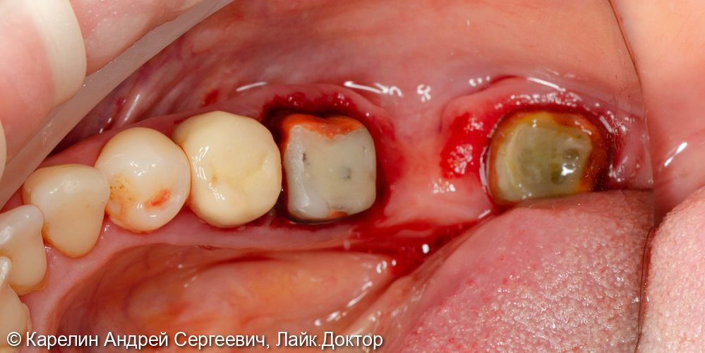 Удаление и одномоментная имплантация в 4 секторе - фото №2