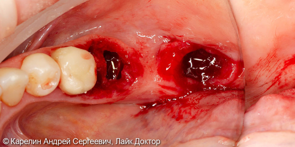 Удаление и одномоментная имплантация в 4 секторе - фото №5