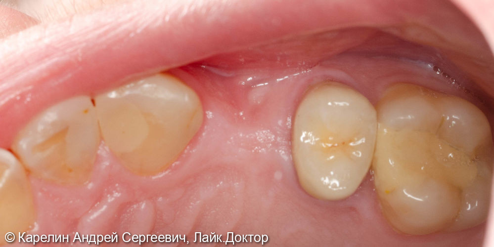 Классическая имплантация в области зуба 2.4 за 15 минут - фото №1