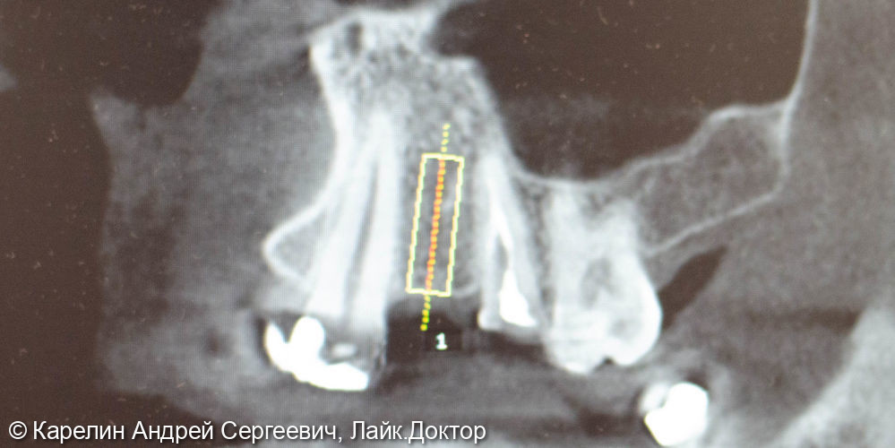 Классическая имплантация в области зуба 2.4 за 15 минут - фото №2
