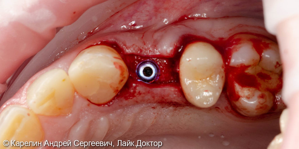 Классическая имплантация в области зуба 2.4 за 15 минут - фото №3