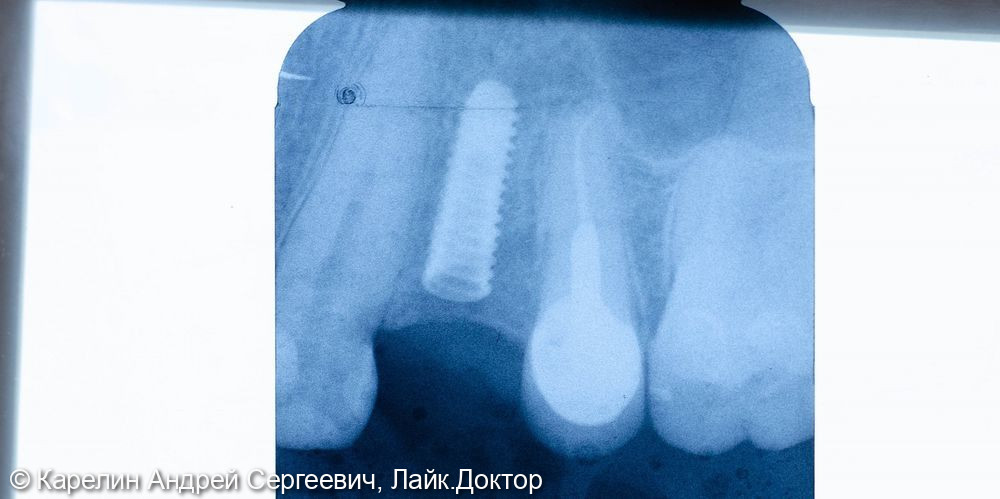 Классическая имплантация в области зуба 2.4 за 15 минут - фото №4