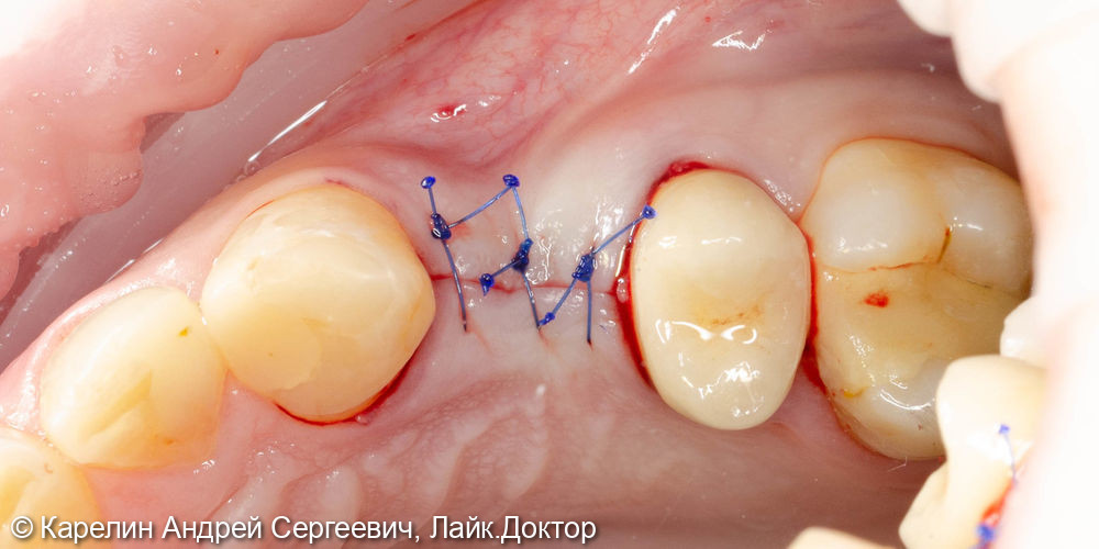 Классическая имплантация в области зуба 2.4 за 15 минут - фото №5