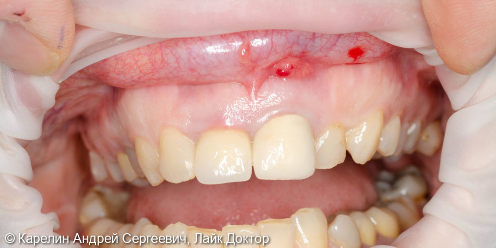 Лечение периодонтита зуба 2.1 и одномоментная с удалением имплантация зуба 1.1 - фото №1