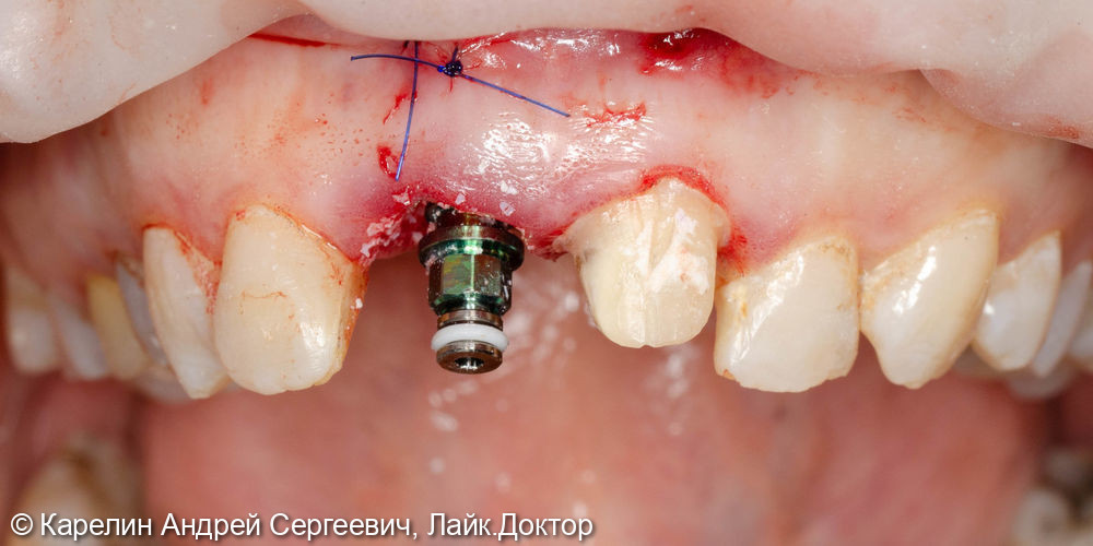 Лечение периодонтита зуба 2.1 и одномоментная с удалением имплантация зуба 1.1 - фото №3