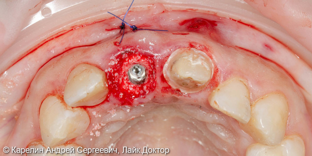 Лечение периодонтита зуба 2.1 и одномоментная с удалением имплантация зуба 1.1 - фото №4