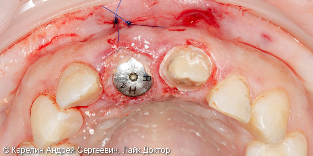 Лечение периодонтита зуба 2.1 и одномоментная с удалением имплантация зуба 1.1 - фото №5