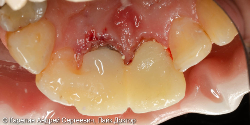 Лечение периодонтита зуба 2.1 и одномоментная с удалением имплантация зуба 1.1 - фото №7