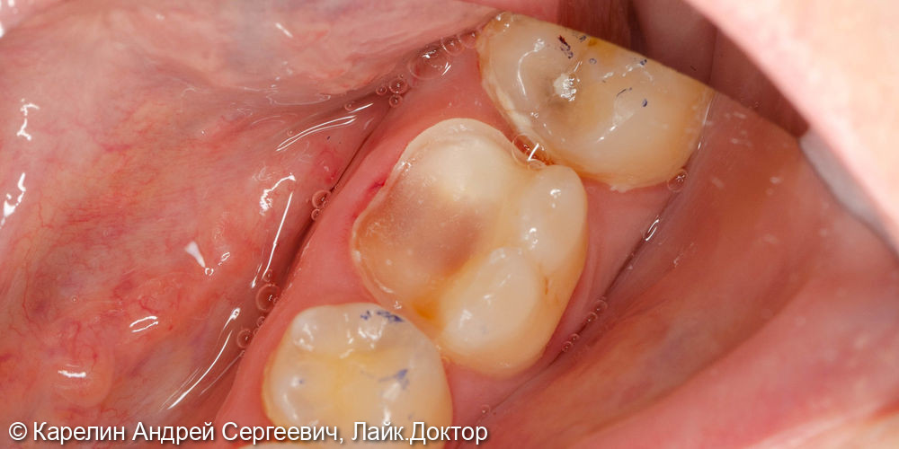 Ортопедическая реставрация зуба 3.6 - фото №1